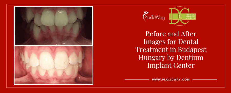 Before and After Images for Dental Treatment in Budapest Hungary