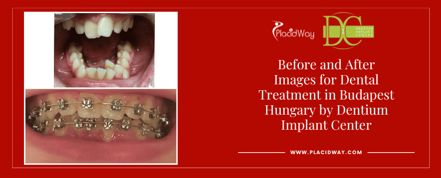 Before and After Images for Dental Treatment in Budapest Hungary
