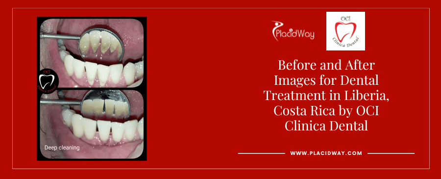 Before and After Images for Dental Treatment in Liberia, Costa Rica by OCI Clinica Dental