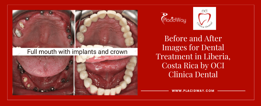 Before and After Images for Dental Treatment in Liberia, Costa Rica by OCI Clinica Dental