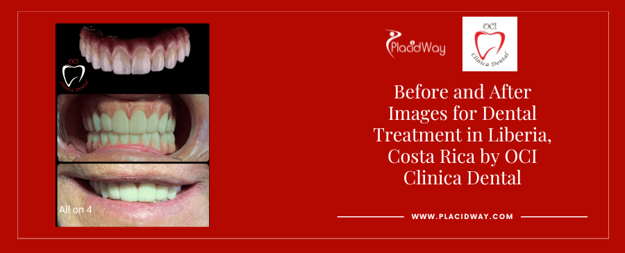 Before and After Images for Dental Treatment in Liberia, Costa Rica by OCI Clinica Dental