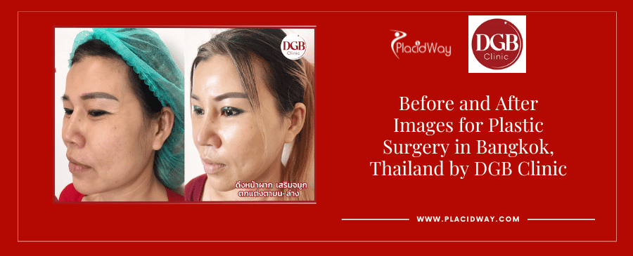 Before and After Plastic Surgery in Bangkok, Thailand 