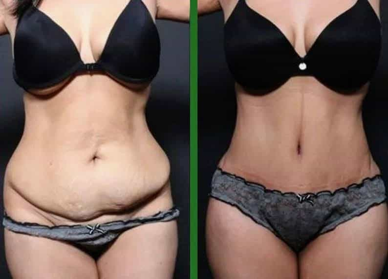 Before After Tummy Tuck in Tijuana Mexico at Gilenis