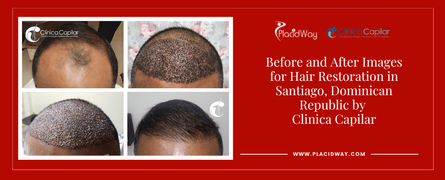 Before and After Images Hair Transplant in Dominican Republic