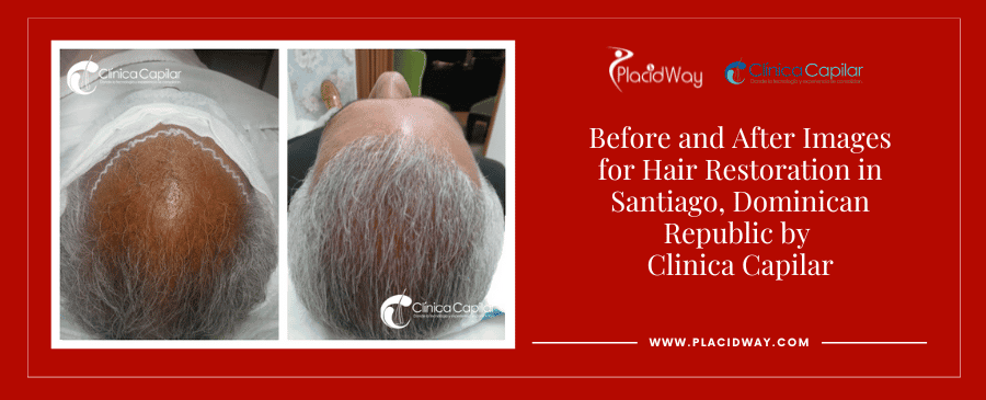 Before and After Images Hair Restoration in Dominican Republic