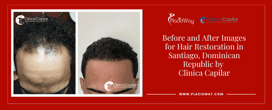 Before and After Images Hair Surgery in Dominican Republic