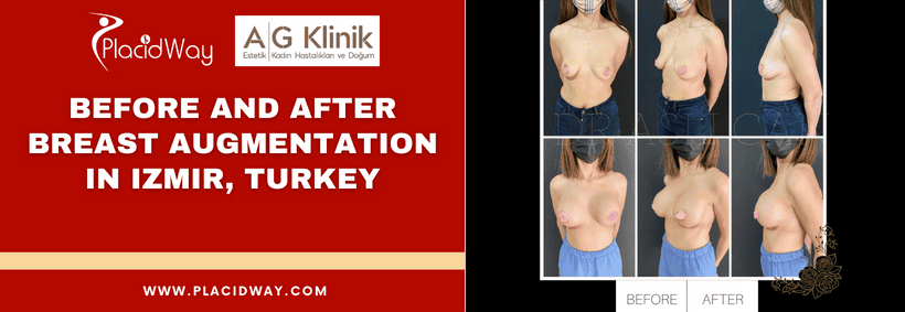 Before and After Breast Augmentation in Izmir, Turkey