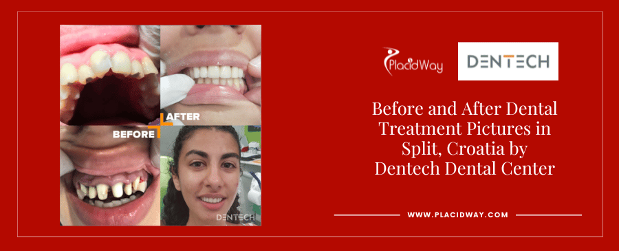 Before and After Dental Implants in Split Croatia at Dentech Dental Centar