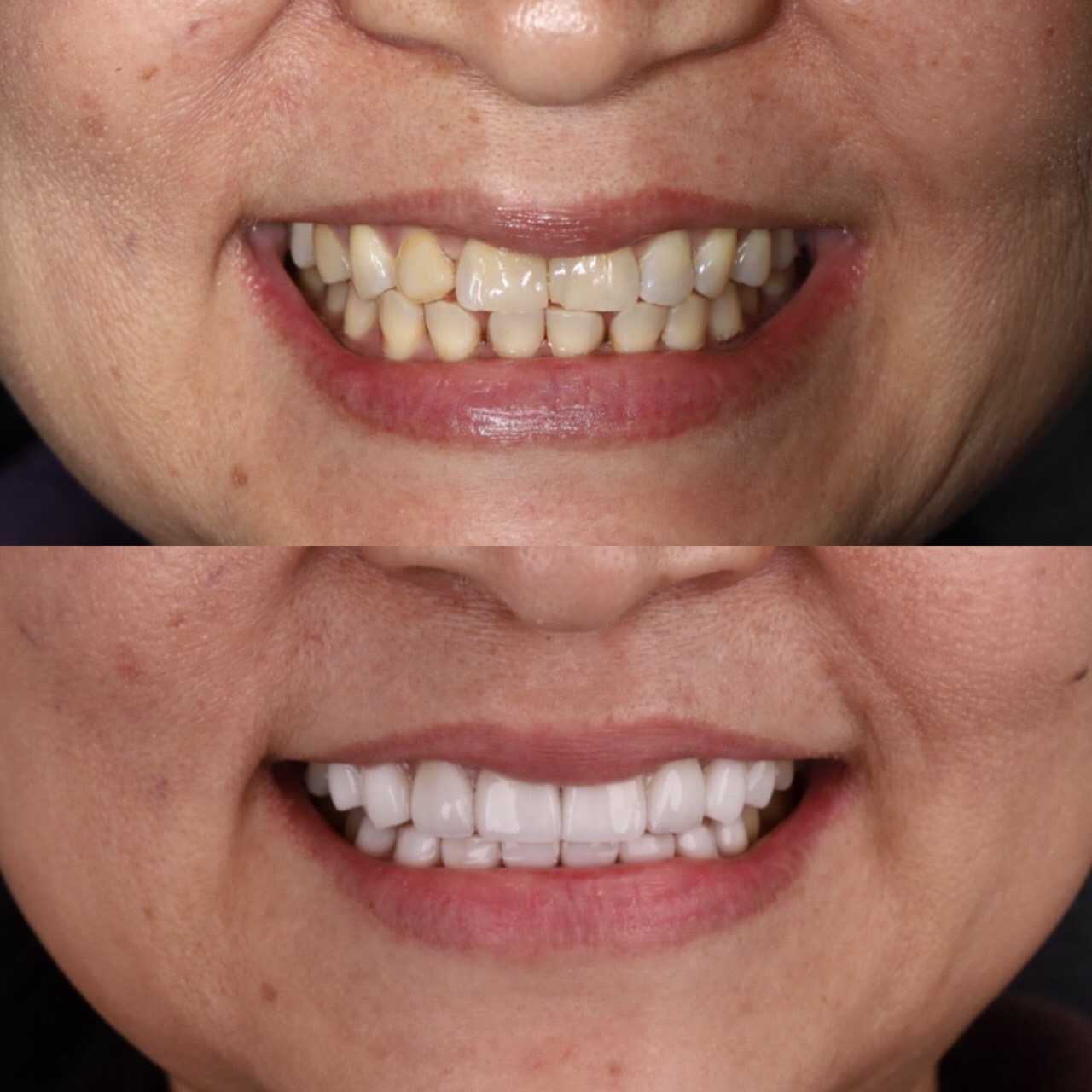 Dr Nicha Ceramic Veneers