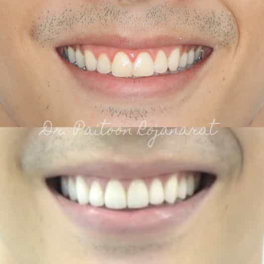 Before After