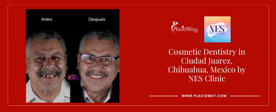 Before and After Cosmetic Dentistry by NES Clinic in Juarez, Mexio