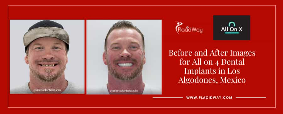 Before and After Images for All on 4 Dental Implants in Los Algodones, Mexico