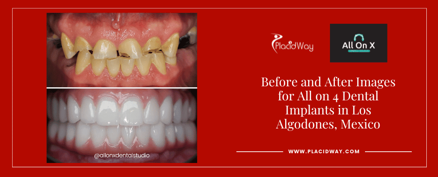 All on 4 Dental Implants in Los Algodones, Mexico Before and After Images