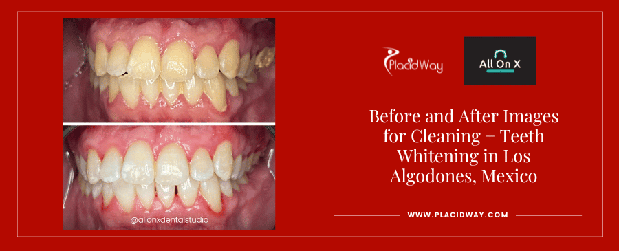 Before and After Image for Teeth Whitening Packages in Los Algodones Mexico