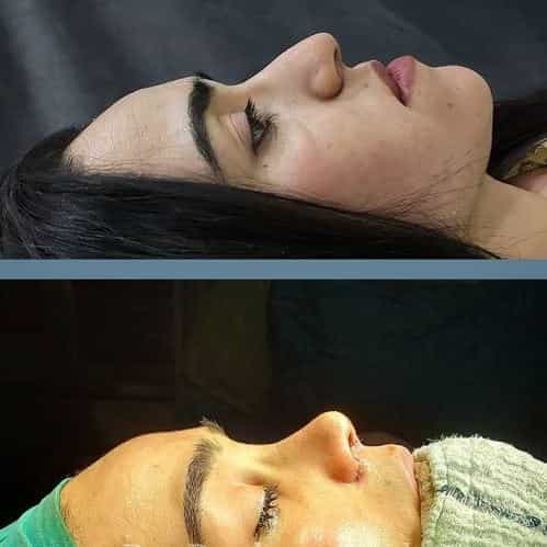 Nose Surgery Before and After