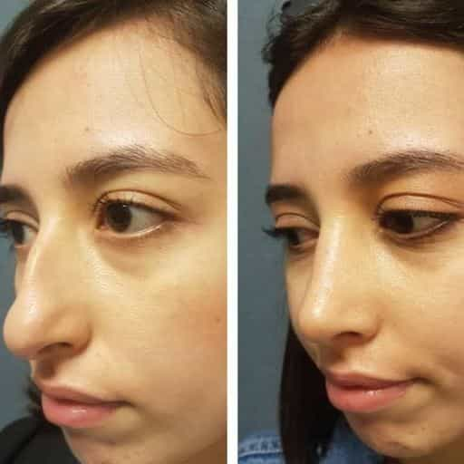 Rhinoplasty Before and After