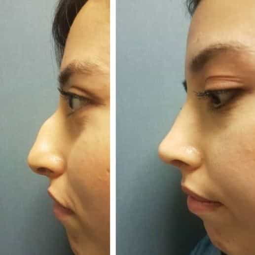 BHT Clinic - Nose Surgery Before and After