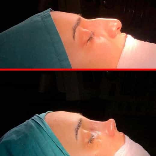 BHT Clinic - Before and After Nose Surgery