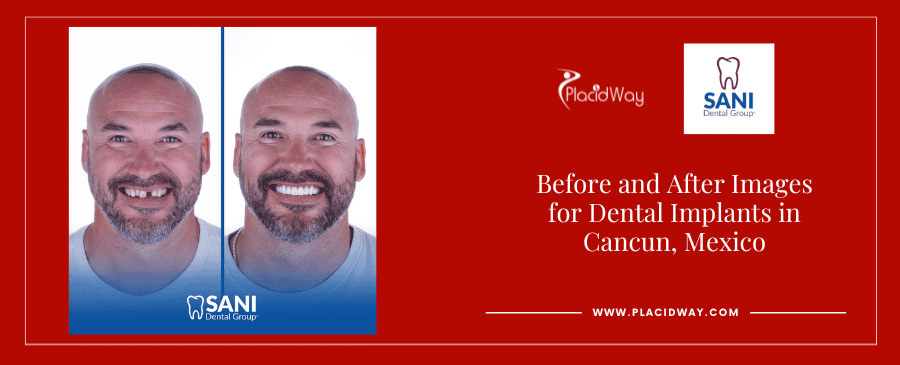 Before and After Images for Dental Implants in Cancun, Mexico