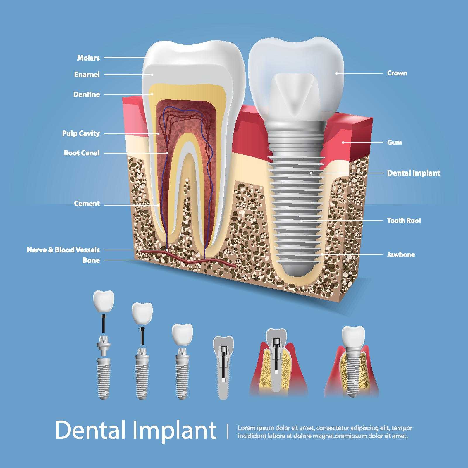 Dental Implants