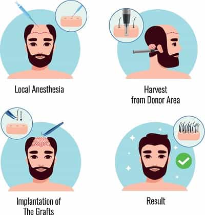 Hair Transplantation Procedures