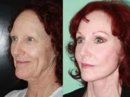 Before and After Facelift Surgery in Tijuana, Mexico