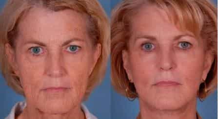 Before and After Facelift in Tijuana at Gilenis