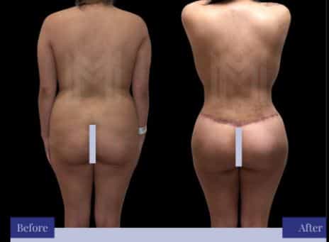 Brazilian Butt Lift Packages in Tijuana, Mexico Before After