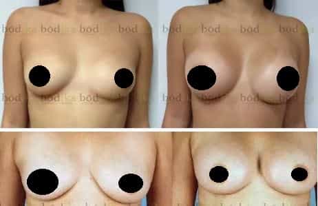 breast implants in tijuana mexico before after gilenis