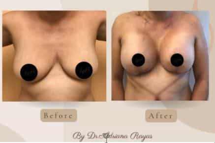 breast implants in tijuana mexico before after lifot