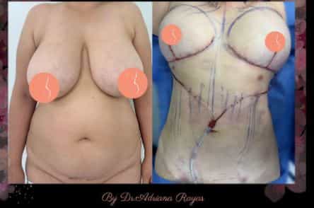 breast augmentation in tijuana mexico before after lifot