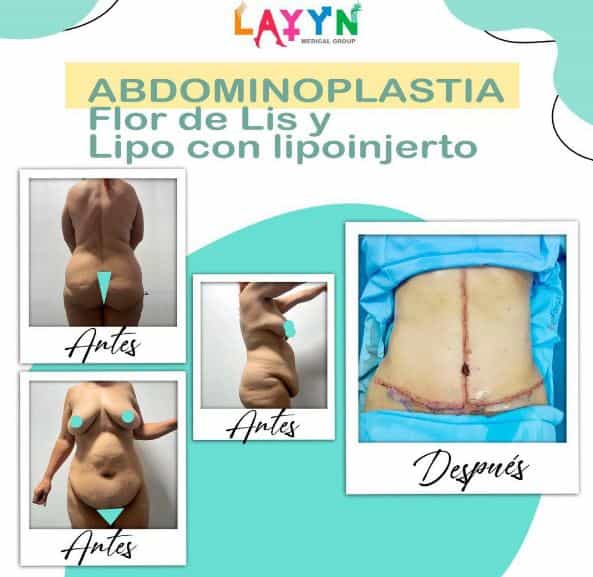 Tummy Tuck in Tijuana Before After Image