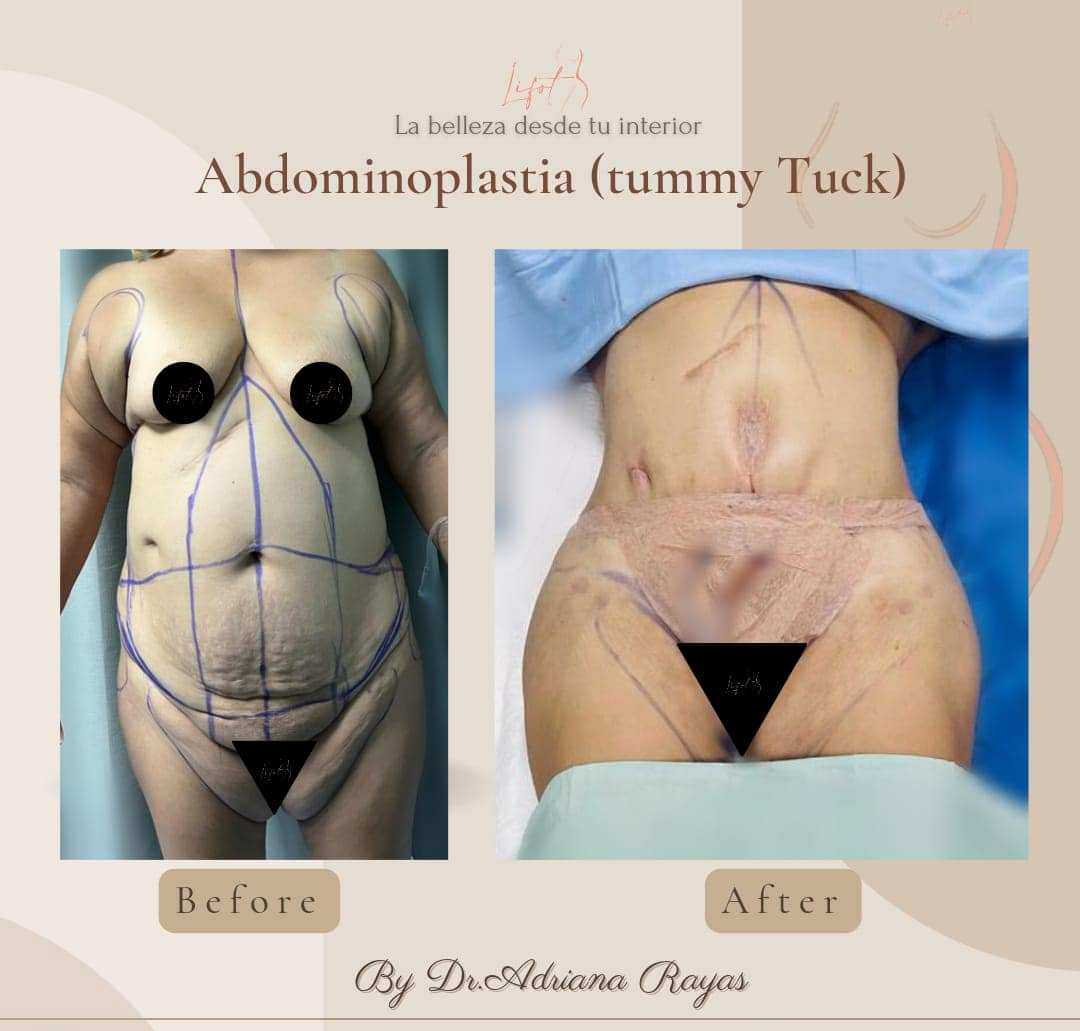 Before After Tummy Tuck LIFOT