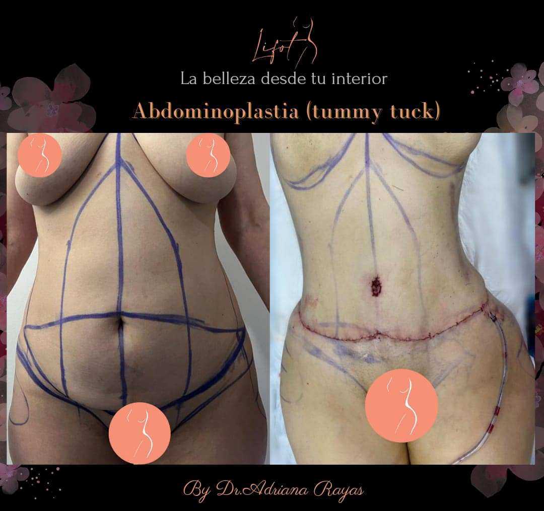 Before After Tummy Tuck in Tijuana by LIFOT