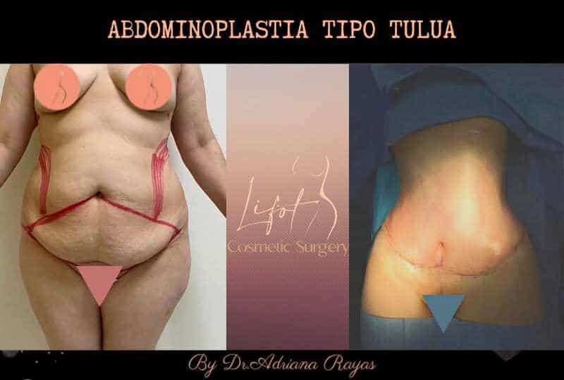 Before and After Images for Tummy Tuck by LIFOT 