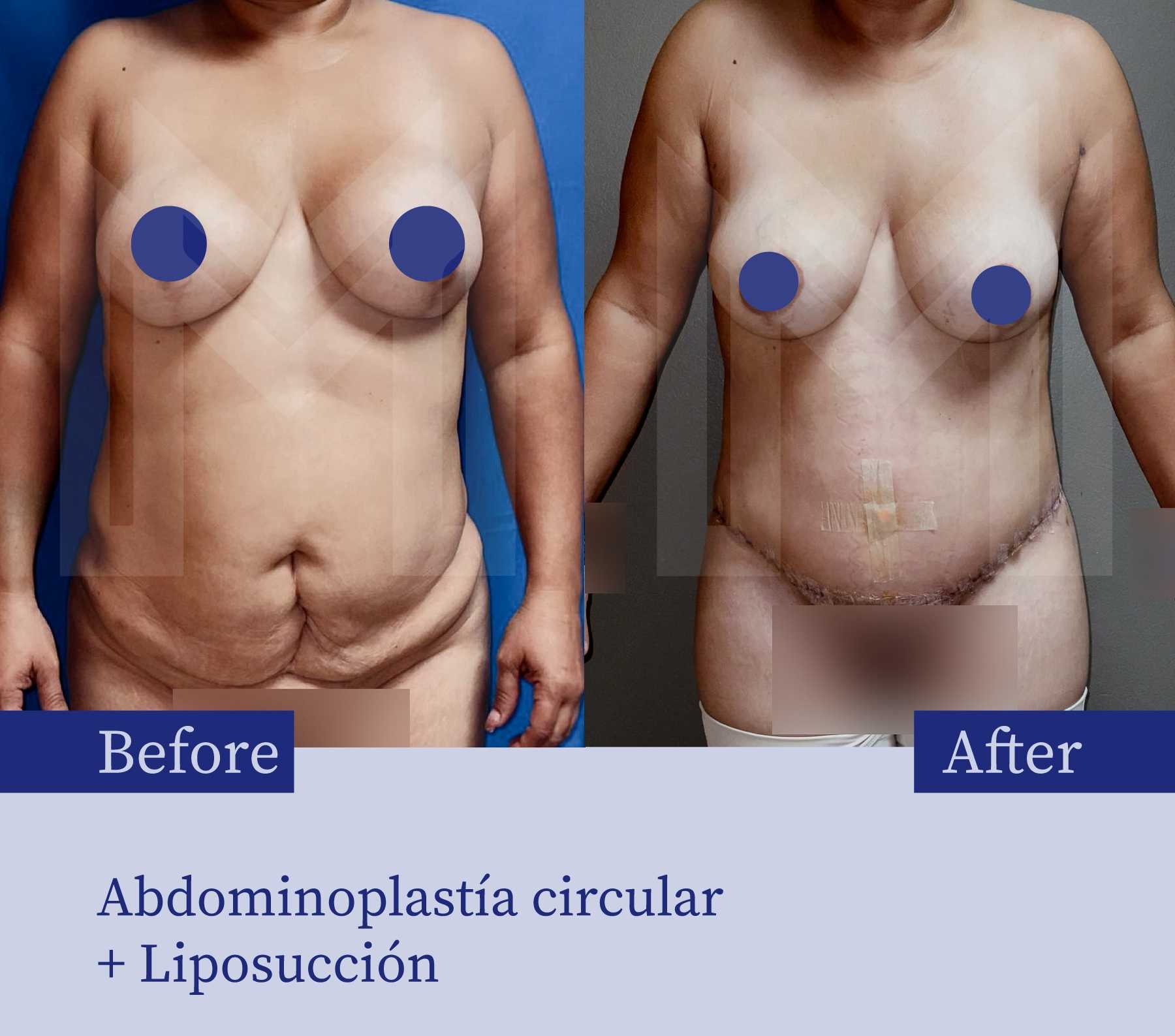 Before After Tummy Tuck Marciales in Tijuana Mexico