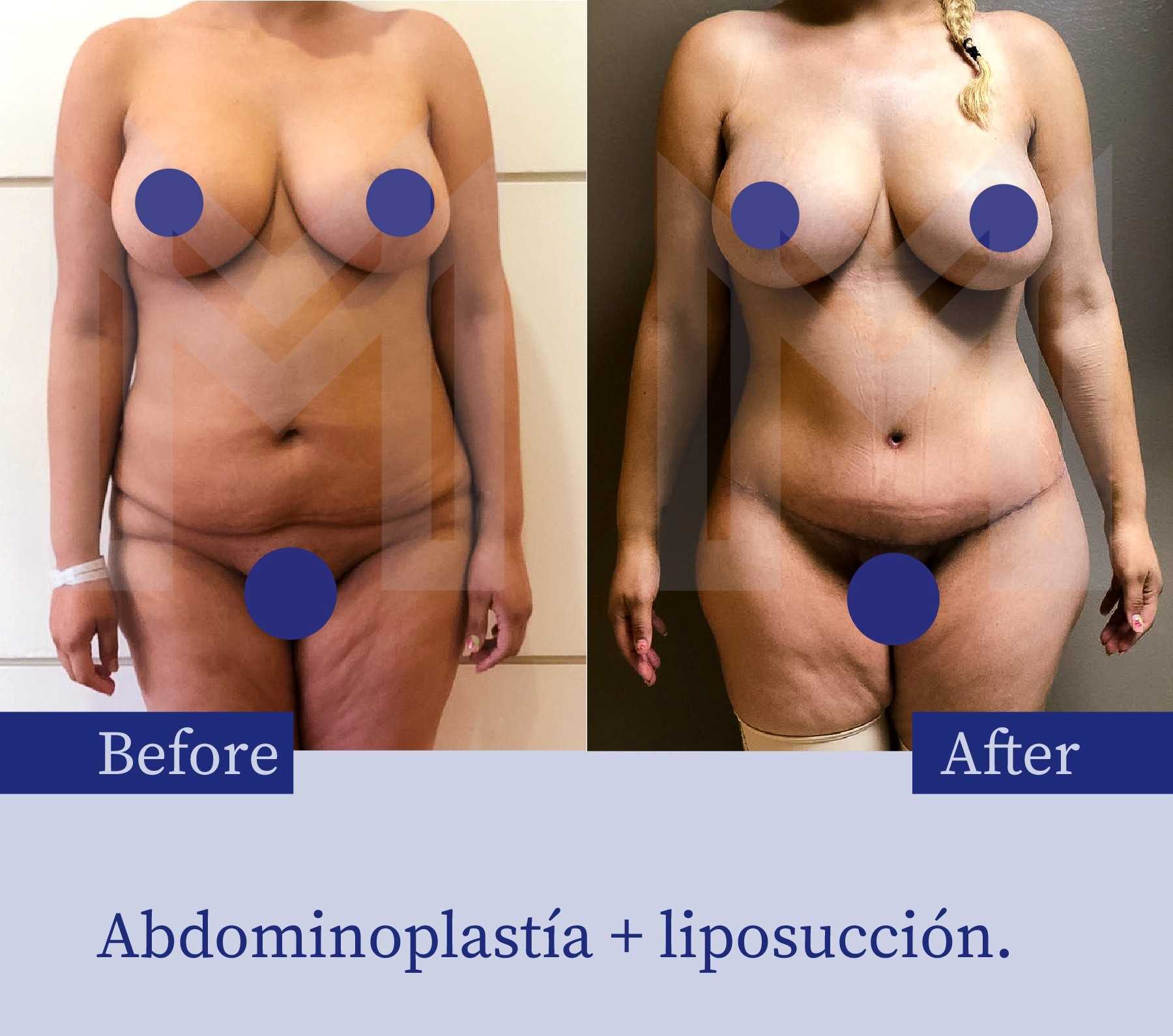 Before After Tummy Tuck in Tijuana by Marciales 