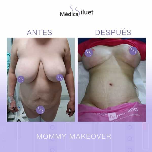 Mommy Makeover in Tijuana Mexico Before and After Images