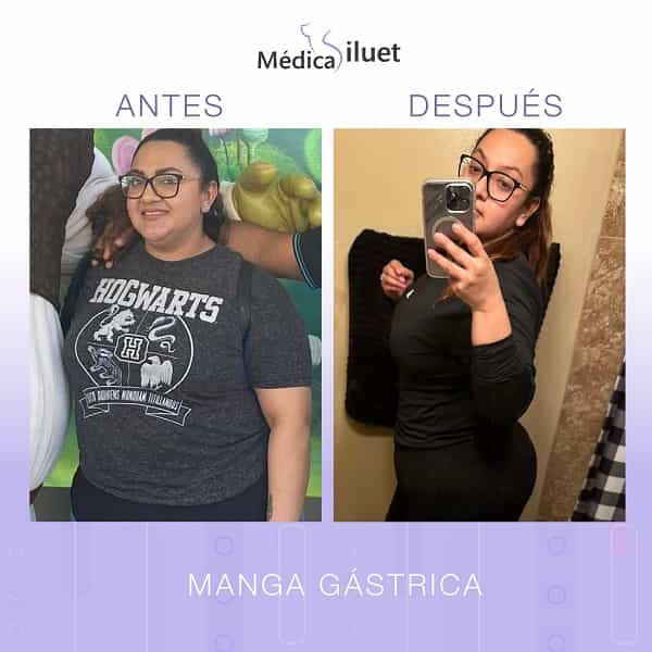 Gastric Sleeve in Tijuana Mexico Before and After Images