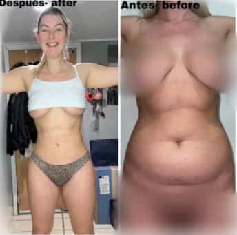 Lipo 360 Before and After Images
