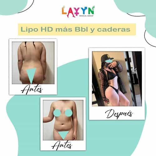 Before and After Images Liposuction in Tijuana Mexico