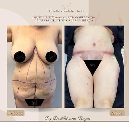 Imágenes de antes y después de cirugía de liposucción en Tijuana, México