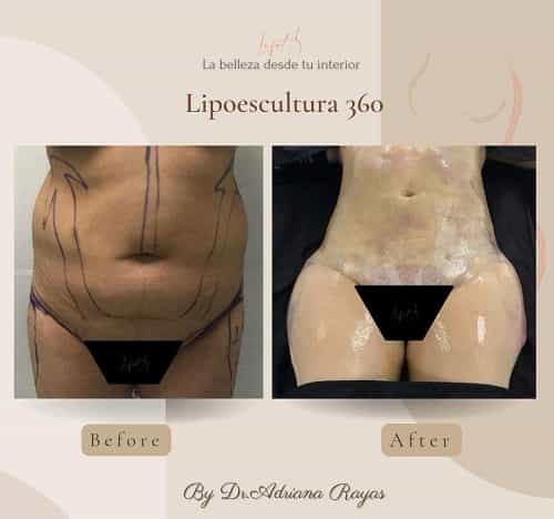 Imágenes de antes y después de la cirugía de liposucción Lifot en Tijuana, México