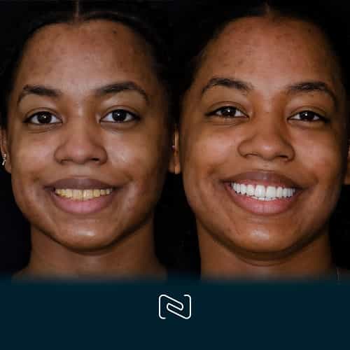 Before and After - Neo Dental Cancun - Cosmetic Dentistry