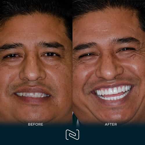 Before and After - Neo Dental Cancun - Dental Veneers