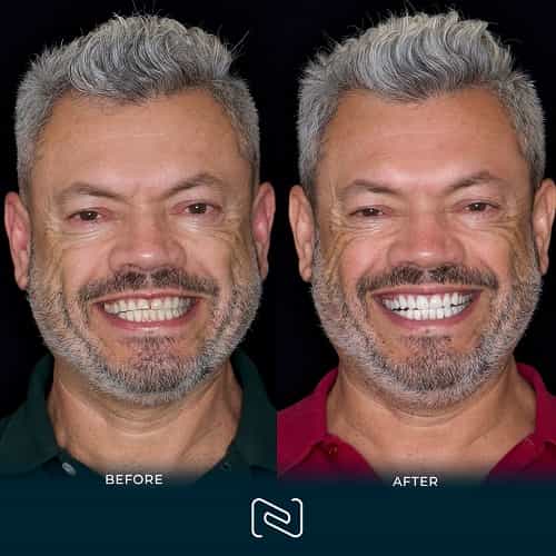 Before and After - Neo Dental Cancun - Dental Veneers and Crowns