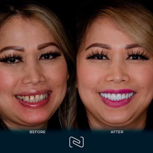 Before and After - Neo Dental Cancun - Smile Makeover