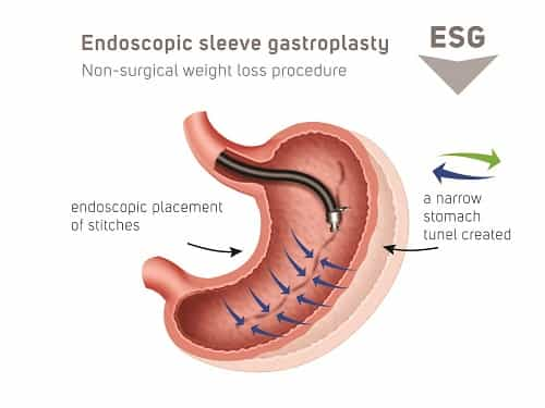 Endoscopic Sleeve Gastroplasty