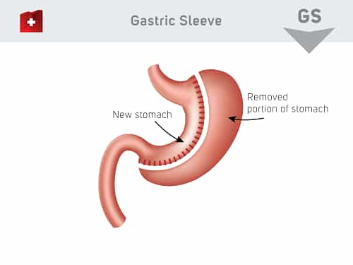 gastric sleeve surgery