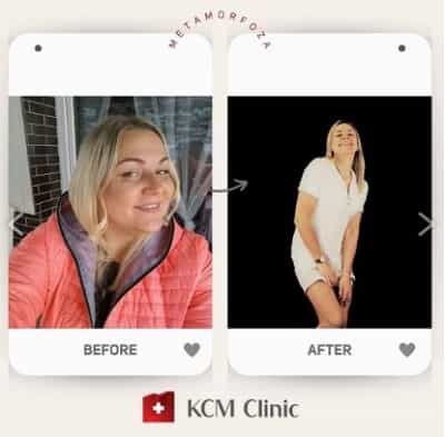 KCM Clinic Before and After Gastric Sleeve in Jelenia Gora, Poland